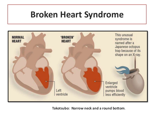Broken heart syndrome medical illustration