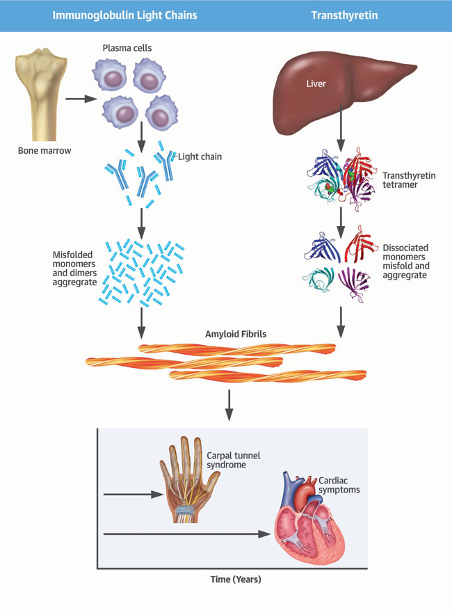 Mechanism of Amyloid Deposition Illustration