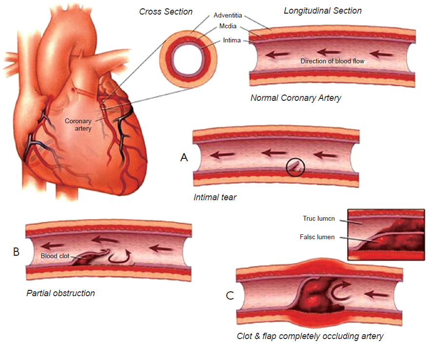 Heart and arteries, shows blood flow and intimal tear. 