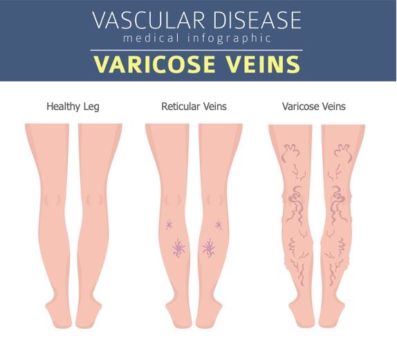 Image of three set of legs. One healthy legs, one set with reticular veins, and the last set of legs with varicose veins. 